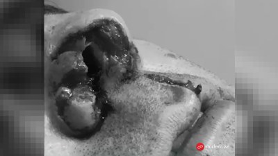 Azərbaycanda it kişinin burnunu qopardı -&nbsp;Həkimlər yerinə tikdilər -&nbsp;FOTOLAR