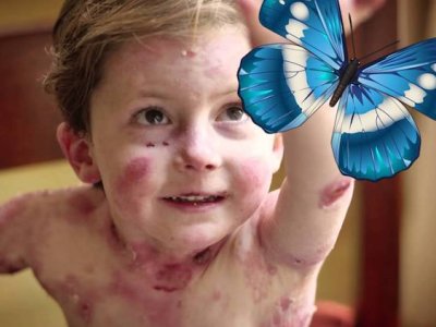 Kəpənək xəstəliyi ilə mübarizəyə&nbsp;1,3&nbsp;milyon&nbsp;vəsait ayrıldı