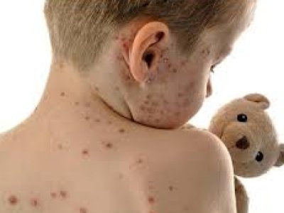 Uşaqlar arasında suçiçəyi xəstəliyi yayılıb -&nbsp;VİDEO