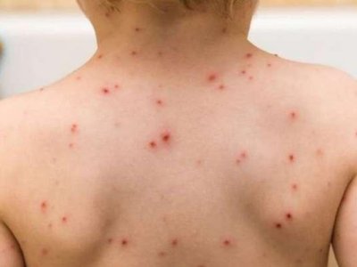 Azərbaycanda 1 yaşlı uşaq qızılcadan öldü