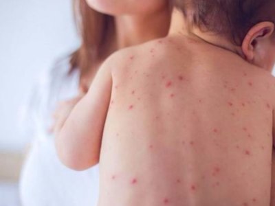 Azərbaycanda 10 nəfər qızılcaya&nbsp;yoluxub