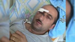 Döyülən jurnalistin gözündə ciddi problemlər yaranıb