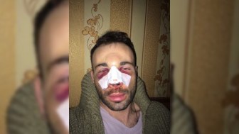 Jurnalist vəhşicəsinə döyüldü - FOTO