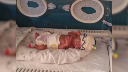 Azərbaycanda 650 qram çəkidə doğulan körpə 33 gündür yaşadılır - FOTO