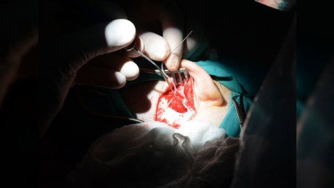 Tibb Universitetinin həkimləri 3 yaşlı uşağın eşitmə qabiliyyətini bərpa etdilər - FOTO