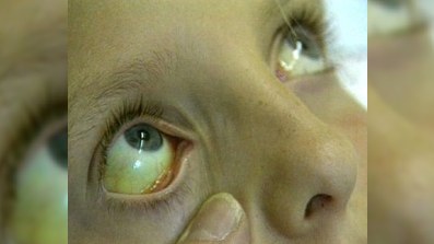 Hepatitlərə yoluxmağından şübhələnənlər üçün pulsuz MÜAYINƏ