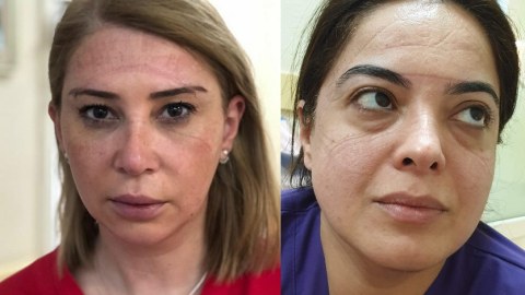 Günümüzün qəhrəmanları: Virusla mübarizə aparan həkimlər - “İnsanlarımıza deyin ki...” - FOTOLAR