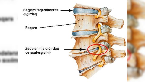 Osteoxondroz və onun MÜALİCƏSİ