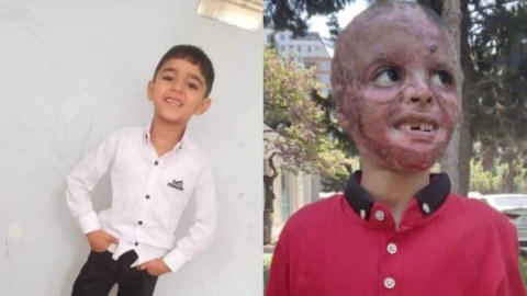 Balaca Gülməmmədin müalicəsi üçün 90 min manat lazımdır
