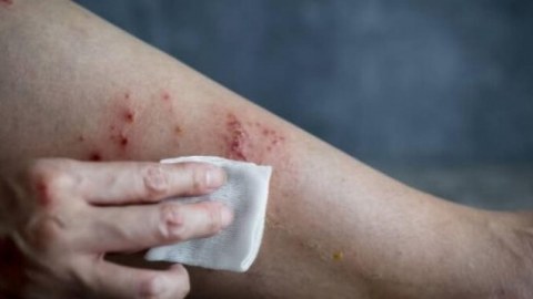 Meymunçiçəyinə qarşı kütləvi vaksinasiya aparılacaq? - ÜST-dən açıqlama