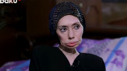 Ayna Sultanovanın nəticəsi: “Erməni tibb bacısı məni əlil etdi” – VİDEO