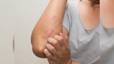 Allergiya tamamilə müalicə olunmur