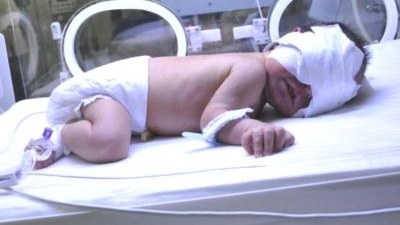 Erkən doğulan uşaqlarda rast gəlinən ANOMALİYALAR
