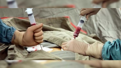 Sümük iliyi transplantasiyası cərrahi müdaxilə olmadan həyata keçiriləcək
