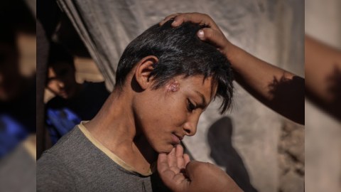 Bu il 31 ölkədə vəba epidemiyası qeydə alınıb - ÜST
