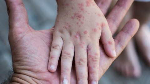 Zaqatalada qızılcaya yoluxanların son durumu