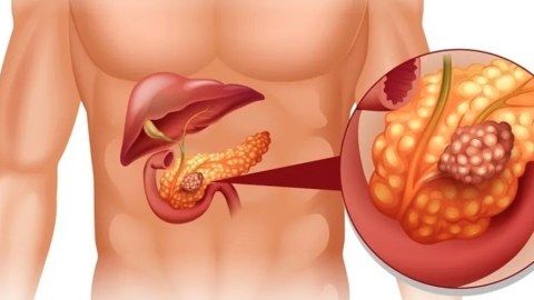 Mədəaltı vəzi xərçəngini 92 faiz dəqiqliklə aşkarlayan test
