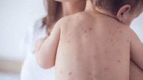 Qızılca zamanı hər an ağırlaşmalar baş verə bilər - Epidemioloq