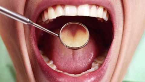 Boğazda xroniki ağrı ağız boşluğu xərçənginin əlamətidir