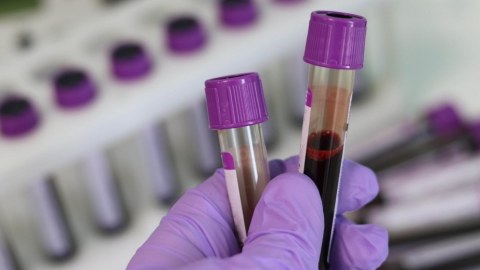 Yüz yaşdan yuxarı insanların qan testlərində 12 mühüm ƏLAMƏT