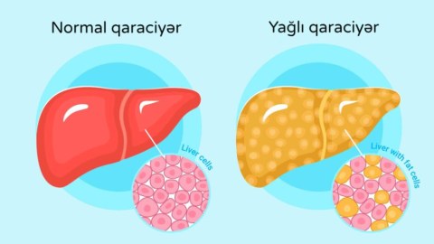 İnsanın çöhrəsi qaraciyərdəki xəstəliklərin əlamətlərini göstərir