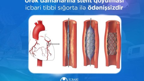 Ürək damarlarına stentin qoyulması pulsuzdur - İcbari tibbi sığorta