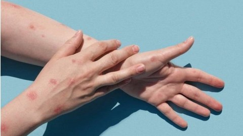 Meymunçiçəyi yayılır: Hansı regionlarda risk daha böyükdür?