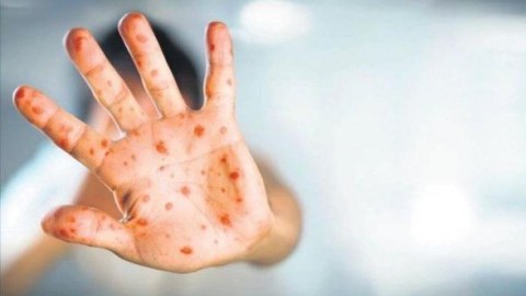 Meymunçiçəyi yayılır: Simptomları nədir və necə yoluxur... 
