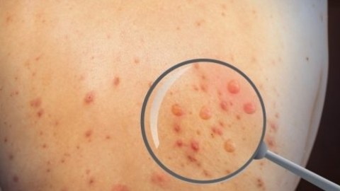 Azərbaycanda meymunçiçəyinə yoluxan var? - Rəsmi AÇIQLAMA