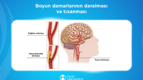 Bu müalicə də icbari tibbi sığortaya daxildir