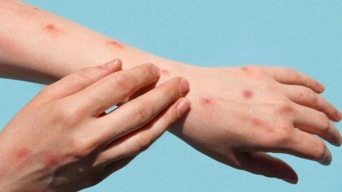 Meymunçiçəyinə yoluxan şəxs evə buraxıldı