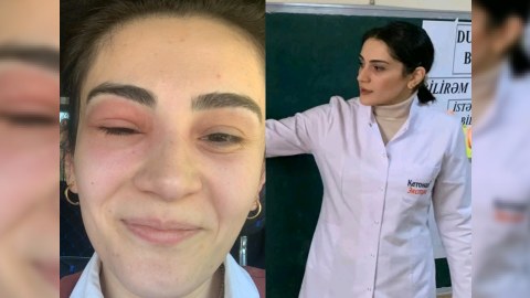 Gözünü arı sancan kimya müəllimi: &ldquo;Tək gözlə 55 bal topladım&rdquo;