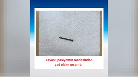 Bakıda azyaşlının mədəsindən mismar çıxarıldı - FOTO