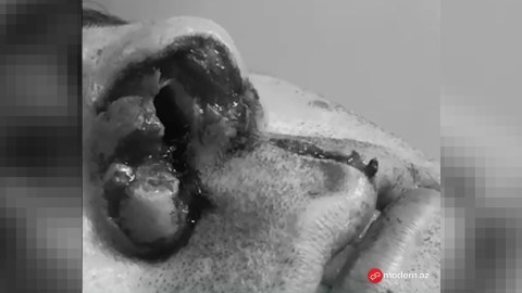 Azərbaycanda it kişinin burnunu qopardı -&nbsp;Həkimlər yerinə tikdilər -&nbsp;FOTOLAR
