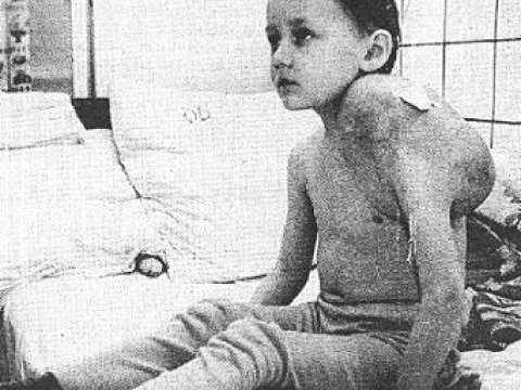 Çernobıl qəzası nəticəsində Azərbaycanda 600-dən çox əlil uşaq doğulub