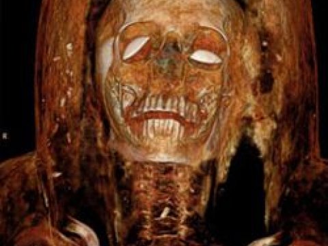 Xərcəng xəstəliyinin yaranmasına elə insanların özləri səbəb olub