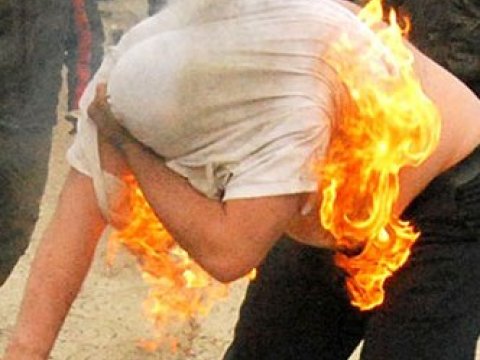 Bakıda borca görə özünü yandıran kişinin üzünə dəri köçürüləcək