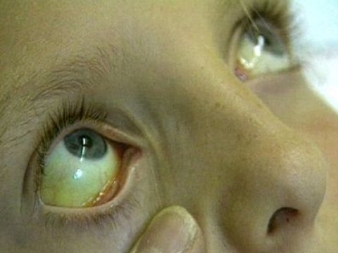 Hepatitlərə yoluxmağından şübhələnənlər üçün pulsuz MÜAYINƏ