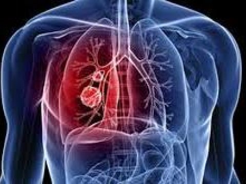 Azərbaycanda 17 kişidə döş vəzi xərçəngi aşkarlanıb