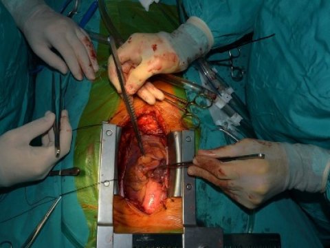 Tibb Universitetində nadir ürək xəstəsi əməliyyat olunub 