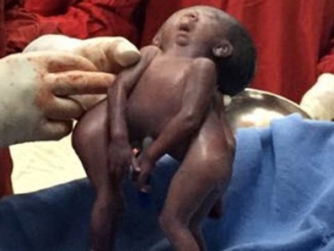 Siam əkizləri öldü