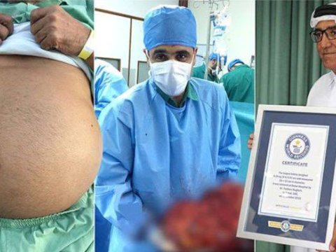 Azərbaycanlı böyrək xəstəsi “Ginnesin rekordlar kitabı”na namizəddir - Eksklüziv - FOTOLAR, VİDEO