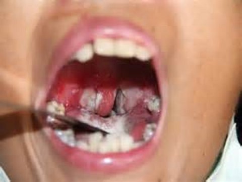 48 nəfər difteriyadan &ouml;ld&uuml; &nbsp;