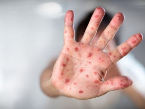 Avropada qızılcadan ölüm halları 4 dəfə artıb