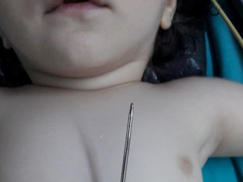 Bakıda 1 yaşlı uşağın qarnına mil batdı - FOTO   