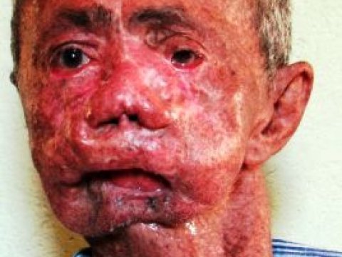 Pulcuqlu dəri, yaşlı uşaq  - İnsanı şoka salan nadir XƏSTƏLİKLƏR
