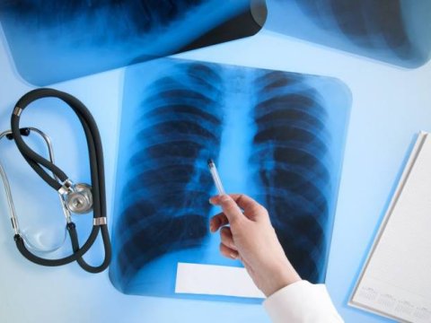 Azərbaycanda 440 nəfər vərəmdən ölüb