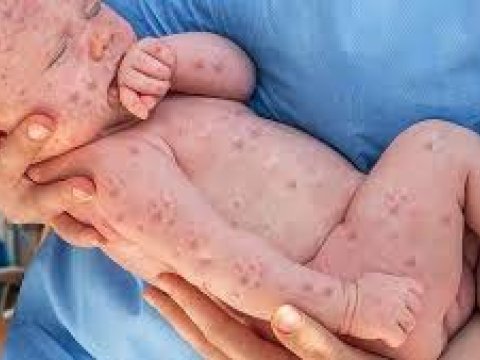 Qızılcaya yoluxanların sayı artıb