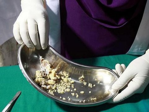 Hindistanda uşağın ağzından 500-dən çox diş çıxarıldı