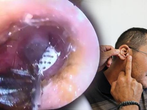 Ağrı ilə həkimə getdi, qulağından kəpənək çıxdı